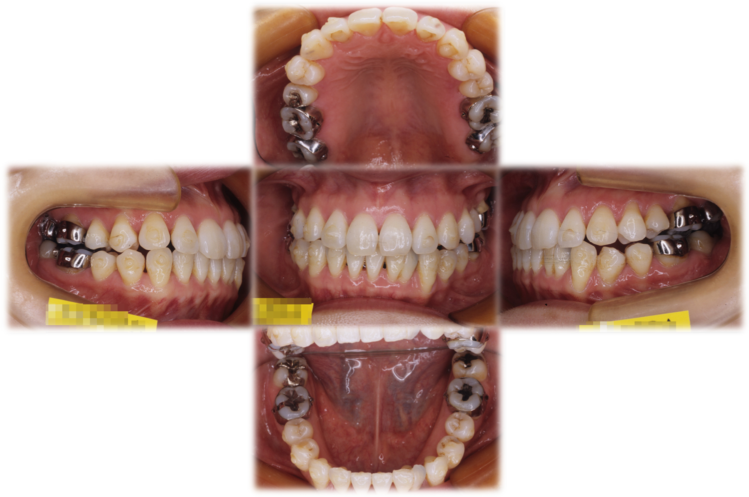 矯正歯科初診時（33歳）