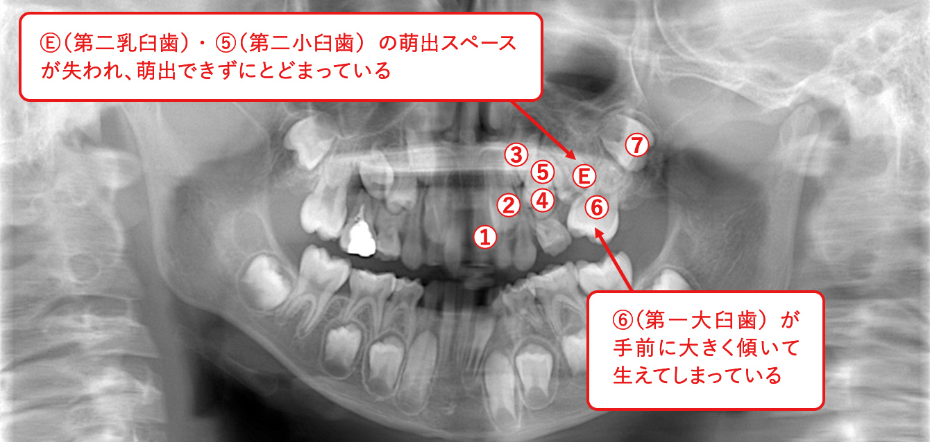 症例1