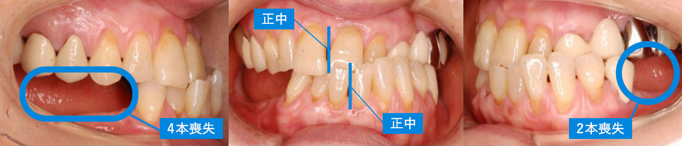 治療前（74歳）