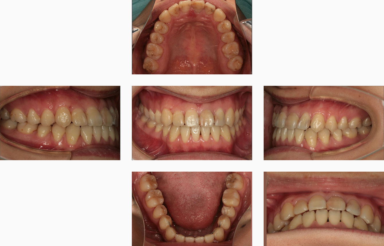 矯正歯科治療終了時の口腔内