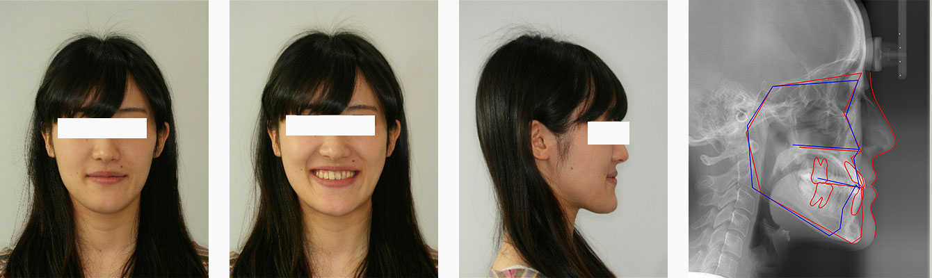 矯正歯科治療終了時の顔貌とセファログラム