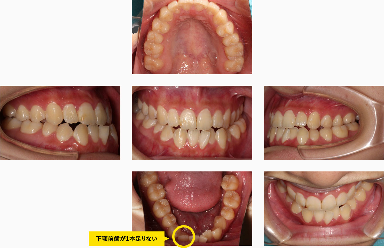 初診時の口腔内