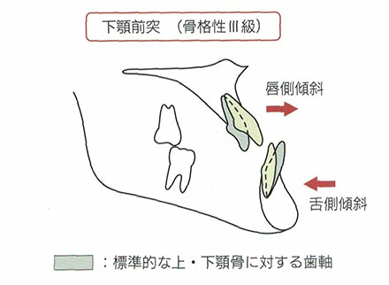 下顎前突