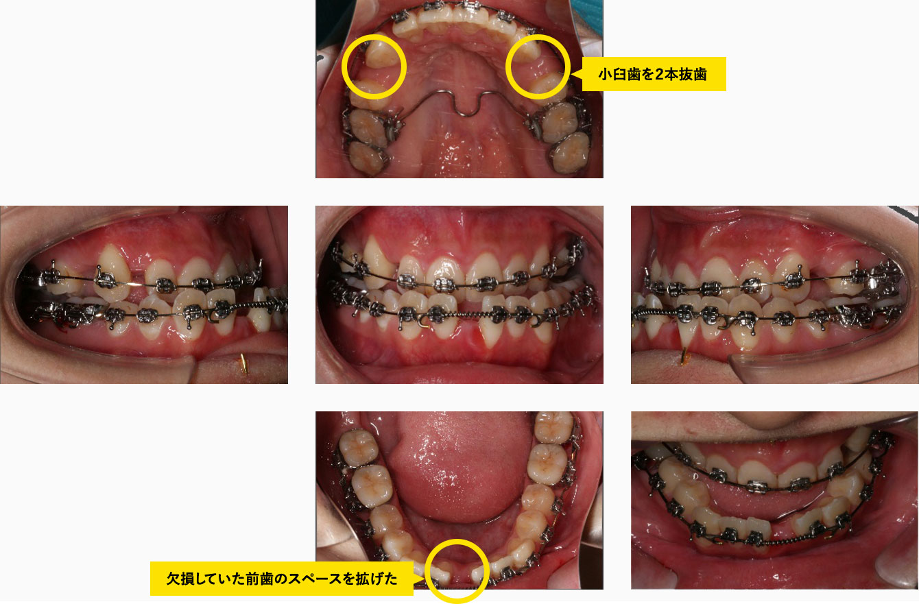 手術直前の口腔内