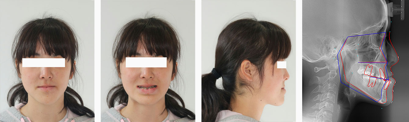 手術直前の顔貌とセファログラム