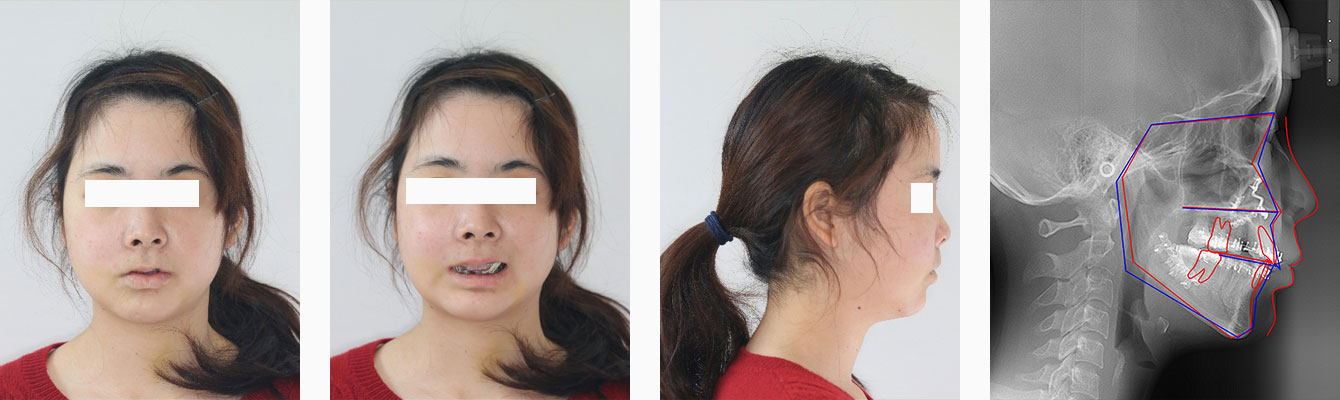 手術後10日の顔貌とセファログラム