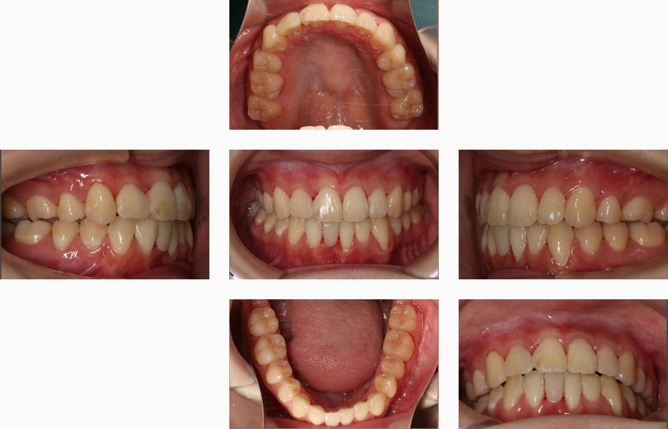 矯正歯科治療終了時の口腔内
