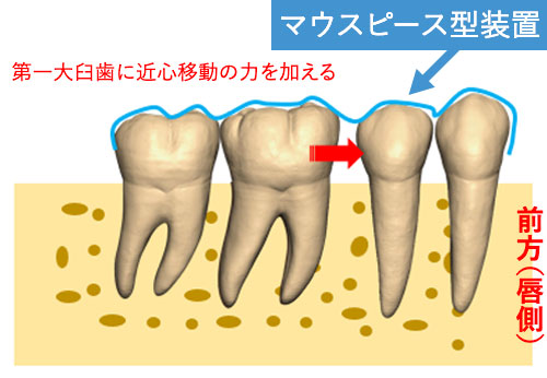 マウスピース型装置を用いて大臼歯を近心に移動する場合