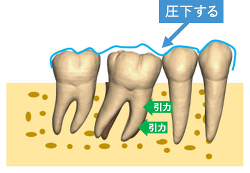 歯槽骨からの反力により、歯根の移動は行えないうえに、上方に引く力が発生しないため、相対的に圧下(あっか/歯肉側に沈む)してしまう