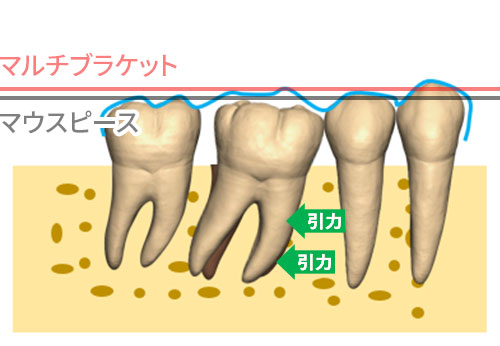 マウスピースを用いた矯正歯科治療