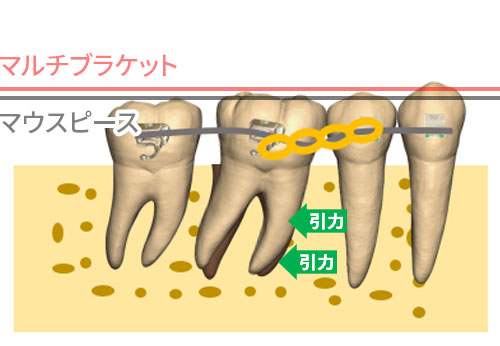 マルチブラケット治療